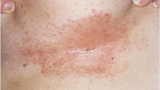 Natural Remedies for Intertrigo Candida of the Skin Folds [upl. by Coe]