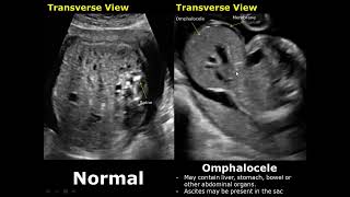 Fetal Bowel Ultrasound Normal Vs Abnormal Image Appearances  Intestine Diseases in Fetus USG [upl. by Ritz]