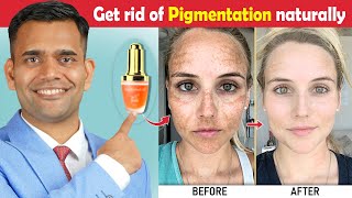 How To Get Rid Of Hyperpigmentation  Ageing or Dark Spots  Naturally Get Rid Of Hyperpigmentation [upl. by Nawor]