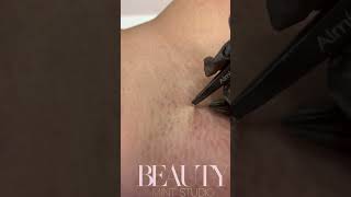 Ingrown Hair Removal [upl. by Tudela]