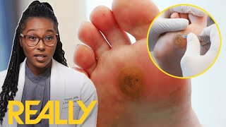 Dr Ebonie Helps Woman With Severe Case Of Foot Callus  My Feet Are Killing Me [upl. by Novyad]