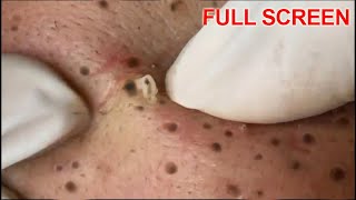 Blackheads Removal  Best Pimple Popping Videos [upl. by Searby]