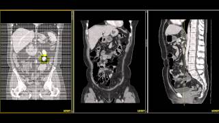 tc abdomen supramesocolico [upl. by Freemon]