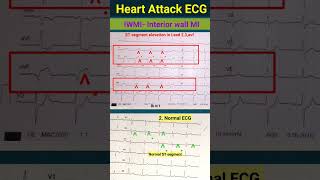 Ecg से हार्ट अटैक का पता कैसे चलता हैं l IWMI l ecg echo shorts [upl. by Holzman]