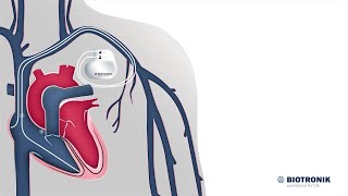 Comment fonctionnent les stimulateurs cardiaques  Animation médicale [upl. by Prendergast]