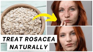 DIY Rosacea Treatments Natural Remedies That Actually Work  Skincare Tips [upl. by Rainger247]