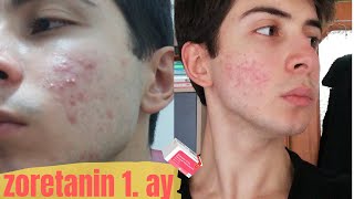 Zoretanin sivilce Tedavisi 1ay  Roaccutane  Aknetrent  Acnegen  gün gün değişim [upl. by Ahsiakal630]