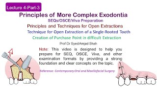 Lecture 4 Part3 SEQs  Open Extraction of Single Rooted Tooth  OSCE  VIVA [upl. by Sucy]