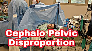 Cephalo Pelvic DisproportionCauses SymptomsTreatmentTrail of labourComplications [upl. by Ahsiket]