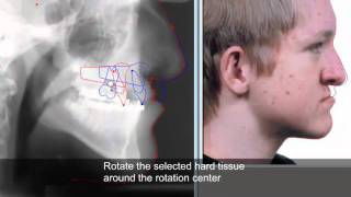 Treatment planning and soft tissue prediction 9 with Facad software [upl. by Neelyar]