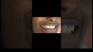 Matching dark gums for upper Anterior implant prosthesis with GCam and Bredent crealign shorts [upl. by Lowery284]