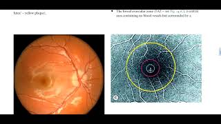 Kanski Clinical Ophthalmology Made Easy  acquired macula diseases1 [upl. by Rahcir]