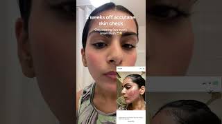 Routine post accutane skin check 🙋🏽‍♀️ I tracked my whole accutane journey on my app “Clear” [upl. by Ahsila]