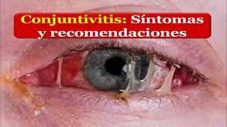 CONJUNTIVTIS Síntomas y recomendaciones en casos de Conjuntivitis [upl. by Arekat]