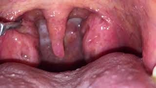 HUGE TONSIL STONES REMOVED [upl. by Anaihr]