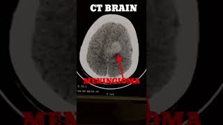 meningioma C T Brain [upl. by Ahseem]