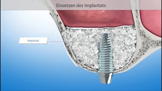 Sinuslift  Sinusbodenelevation 3DAnimation Zahnmedizin [upl. by Ck]