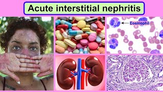 acute interstitial nephritis [upl. by Haraj401]