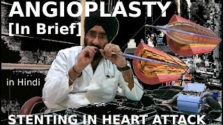 Rx Heart epi 14 h  What is ANGIOPLASTY HINDI Dil me STENT  दिल में छल्ला  DrEDUCATION [upl. by Bacchus878]