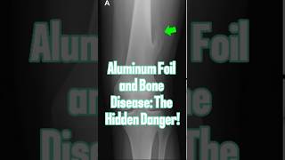 Aluminum Foil and Bone Disease The Hidden Danger [upl. by Lacram737]