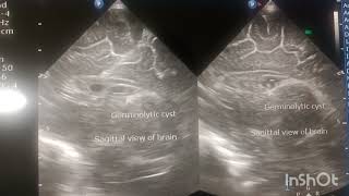 GErminal matrix hemorrhage Germinolytic cyst Connatal Cyst [upl. by Ardaid]