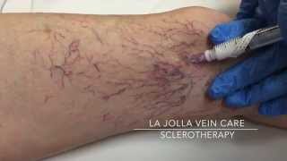 Clearing the Webs Understanding Sclerotherapy Spider Vein Injections [upl. by Warfeld835]