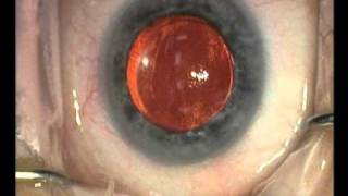 istent for glaucoma [upl. by Aym]