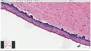 Odontogenic Keratocyst  Histopathology [upl. by Eannaj]