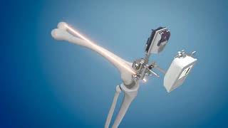 Total Knee Replacement 3D Surgical Animation  KneeAlign [upl. by Nagap]