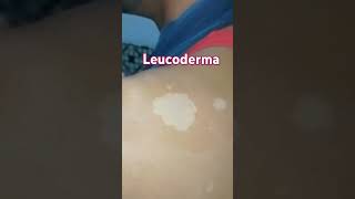 Leucoderma visit Anm herbal health and skincare clinic Lucknow 📞 9235735335 [upl. by Dranrev]