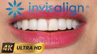 INVISALIGN timelapse  Journey From Deep Overbite to Confident Smile in 4K 💚 [upl. by Guttery]