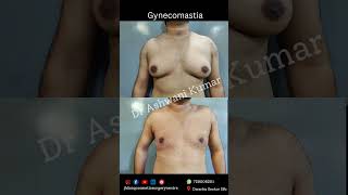 Gynecomastia surgery results day 3 [upl. by Maximilianus]