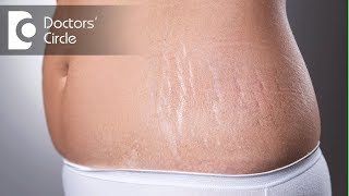 Laser Stretch Marks Removal Treatment In Hyderabad  Best Treatment For Stretch Marks  Hyderabad [upl. by Siloum758]