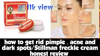 how to rid of acne pimples and dark spotsStillmans Freckle cream honest review [upl. by Sirod]