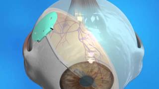 Glaucoma Drainage Implant [upl. by Ahsinut658]