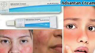 Advantan Cream Review  How to Treat Facial Rash at Home Benefits  How to Use Advantan Cream [upl. by Roddy]