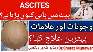 What is Ascites Causes  Symptoms and Best Treatment  پیٹ میں پانی کیوں پڑ جاتا ہے [upl. by Aneet150]