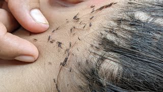 Lice Picking liceremoval lice satisfying fyp omg [upl. by Ashbaugh343]