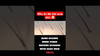 Why do We Get acne skin 🤯 acne acnetreatment acnecauses trendingshorts viral facts foryou fy [upl. by Ynnoj]