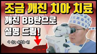 치아가 살짝 깨지셨다구요 BB탄으로 설명해 드립니다 레진 치료전에 보고 가세요 feat 레진 치료의 모든 것 [upl. by Idden]