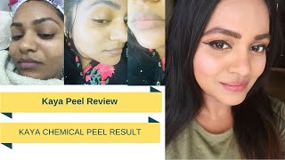 Kaya Skin Peel Treatment ReviewKaya Peel ExperienceChemical Peel India [upl. by Enived]