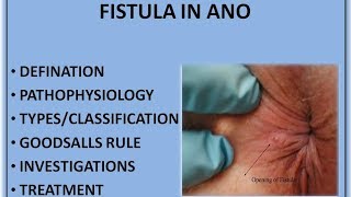 FISTULA IN ANO HINDI [upl. by Adianes]