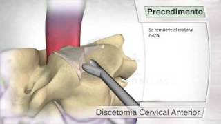 Disectomía cervical anterior [upl. by Fabrienne]