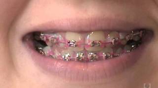 Orthodontic Care Videos  Disclosing Tablets [upl. by Ahsaten]