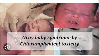 Gray baby syndrome by chloramphenicol toxicity pharmacology contraindications infants [upl. by Trinee128]