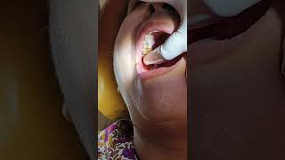 Wisdom tooth removalflap raised [upl. by Retla]