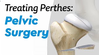 Pelvic Surgery for Treating Perthes Disease in Children [upl. by Ellinnet839]