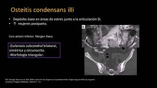 Radiología en 5 minutos Osteitis Condensans Illi [upl. by Meta]