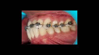 Anterior Crossbite Correction [upl. by Norrabal]