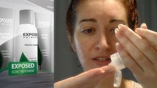 How To Use Exposed Skin Care REQUESTED My At Home Acne Treatment System [upl. by Lezah]